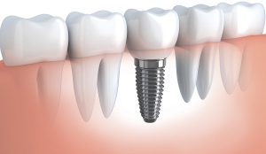 Essential Dental Golden Grove Dental Implant Device