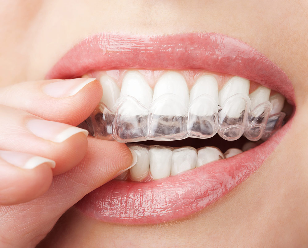 Essential Dental Golden Grove Invisalign teeth straightening