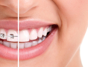 Essential Dental - Braces versus Invisalign