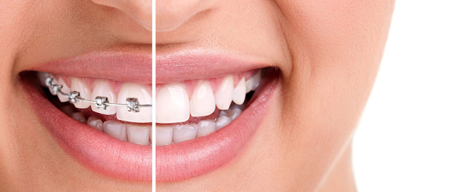 Essential Dental - Braces versus Invisalign