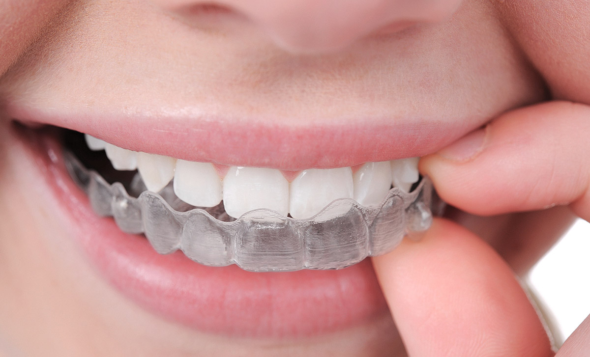 Essential-Dental-Golden-Grove-braces-vs-invisalign-comparison