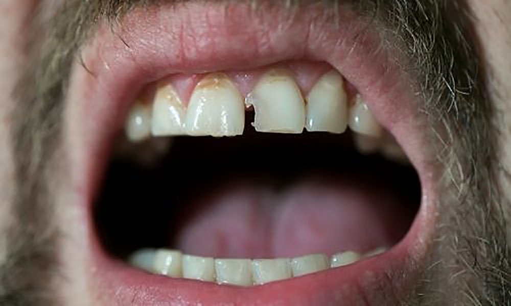 Essential Dental - Cracked Tooth