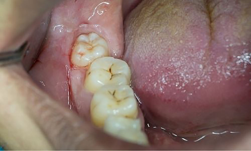 Essential Dental - Wisdom Tooth